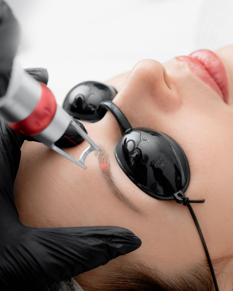 Eyebrow Laser Tattoo Removal