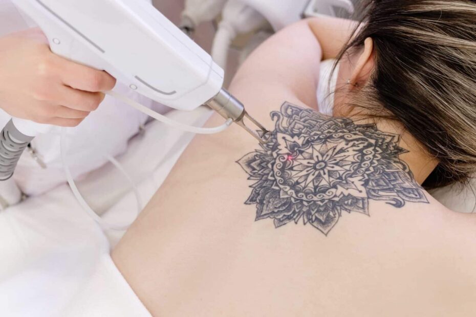 tattoo removal tacoma